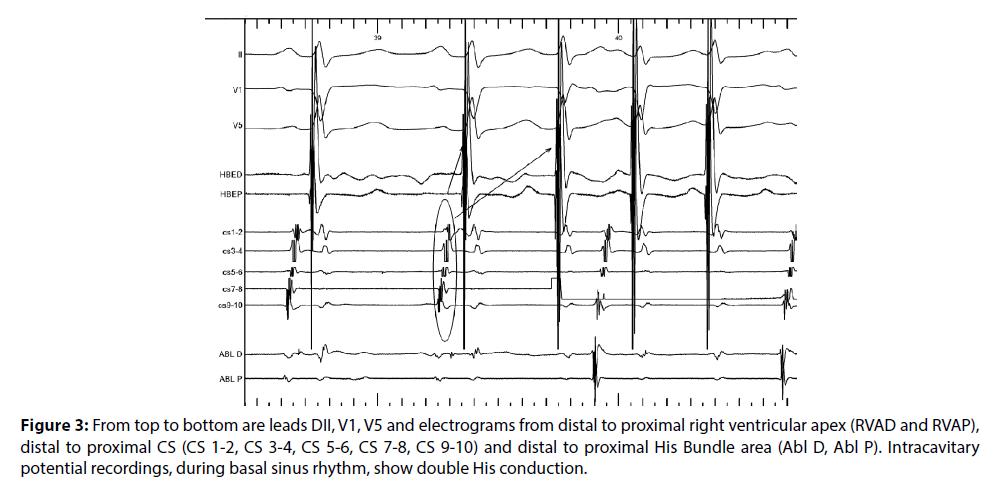 interventional-cardiology-potential-recordings