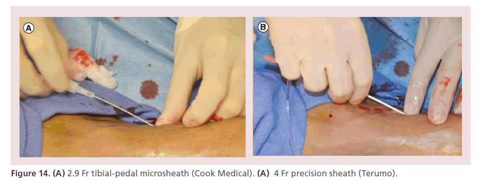 interventional-cardiology-precision-sheath