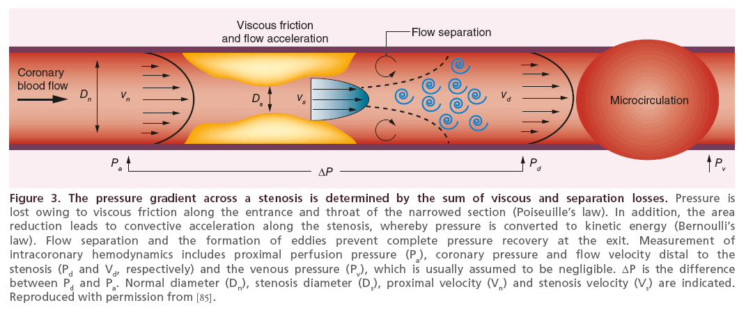 interventional-cardiology-pressure-gradient