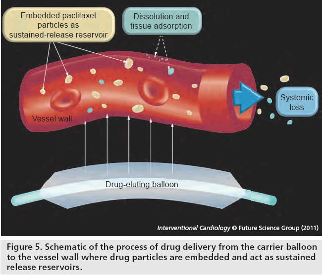 interventional-cardiology-process-drug-delivery