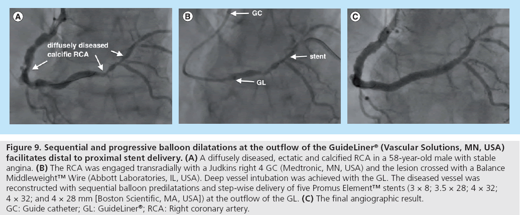 interventional-cardiology-progressive-balloon-dilatations