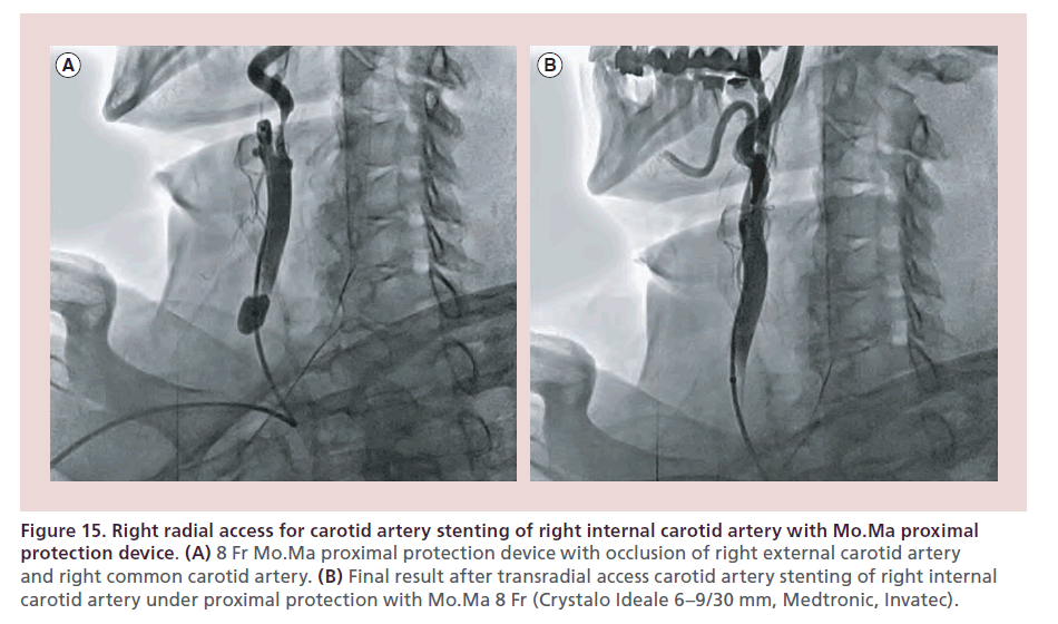 interventional-cardiology-protection-device