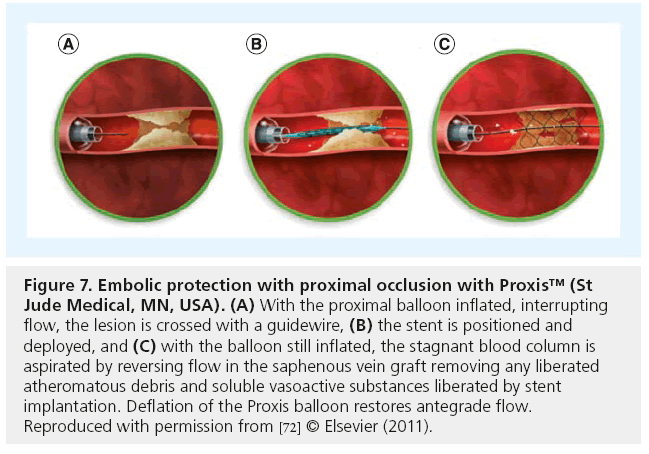 interventional-cardiology-proximal-occlusion