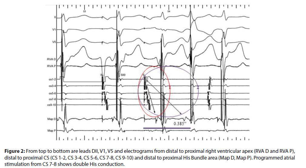 interventional-cardiology-proximal-right