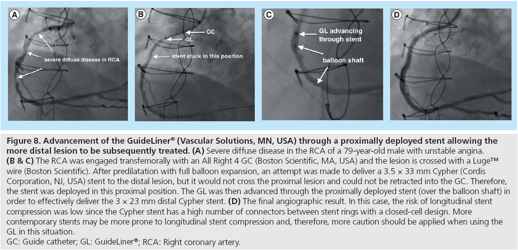 interventional-cardiology-proximally-deployed-stent