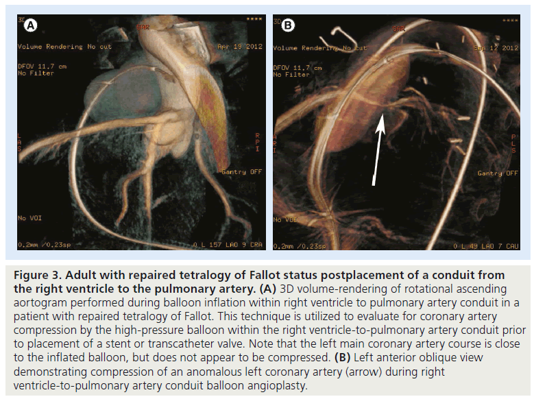 interventional-cardiology-pulmonary-artery