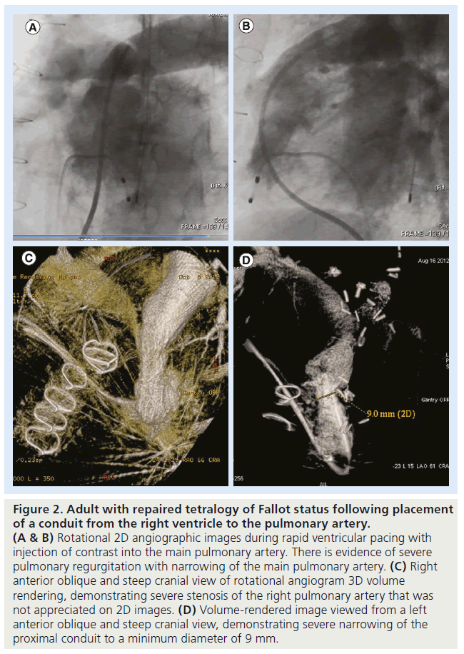interventional-cardiology-pulmonary-regurgitation