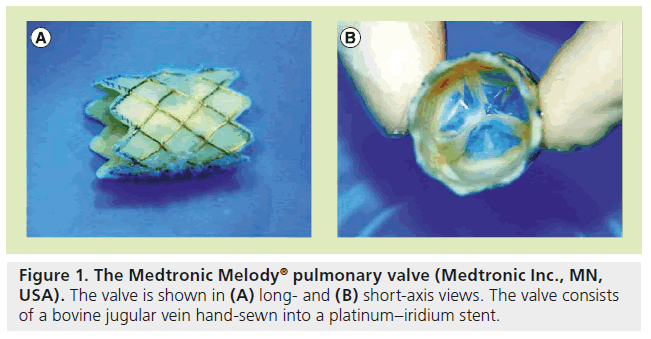 interventional-cardiology-pulmonary-valve