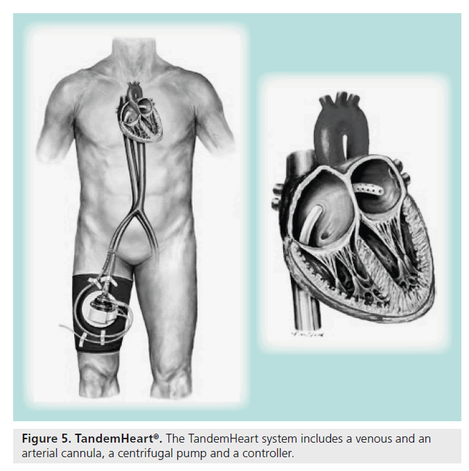 interventional-cardiology-pump-controller