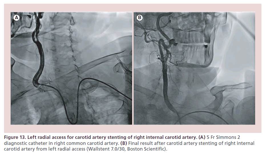 interventional-cardiology-radial-access