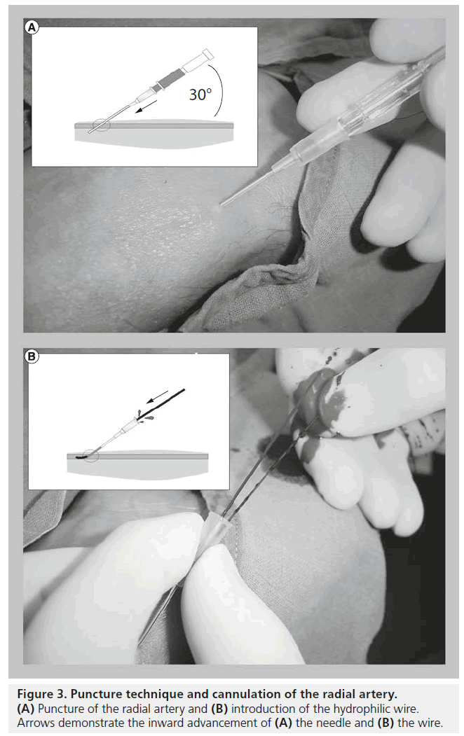 interventional-cardiology-radial-technique