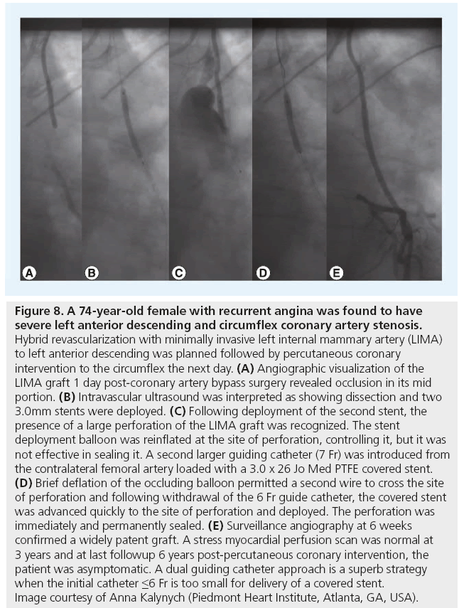 interventional-cardiology-recurrent-angina