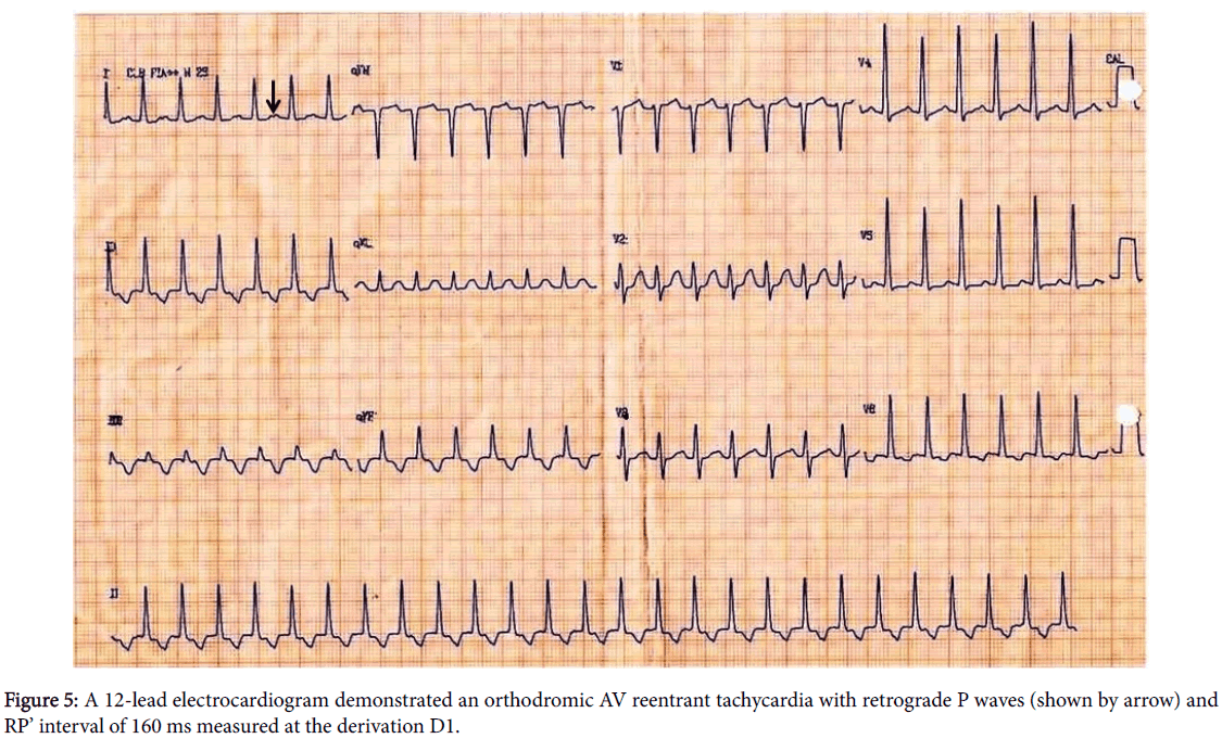 interventional-cardiology-reentrant-tachycardia