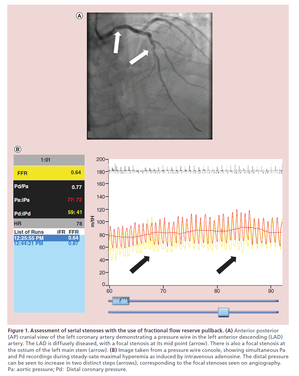 interventional-cardiology-reserve-pullback