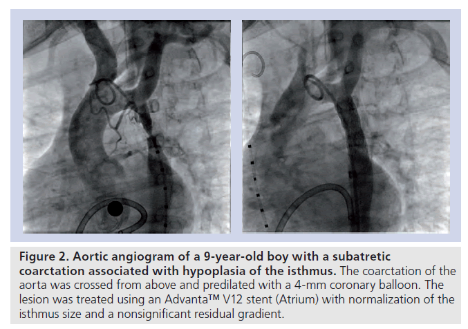 interventional-cardiology-residual-gradient