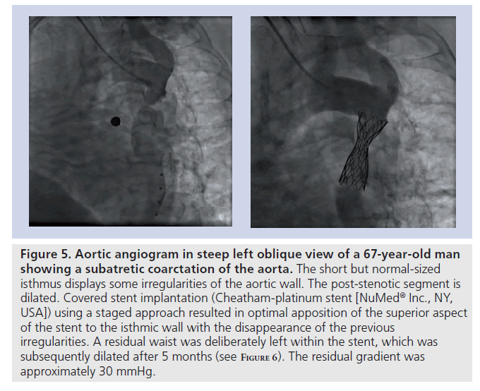 interventional-cardiology-residual-gradient