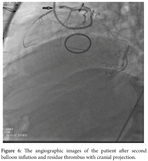 interventional-cardiology-residue-thrombus