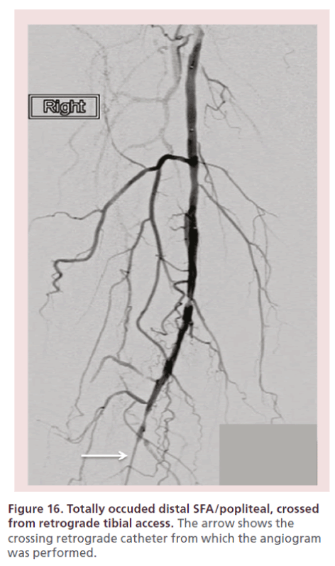 interventional-cardiology-retrograde-tibial