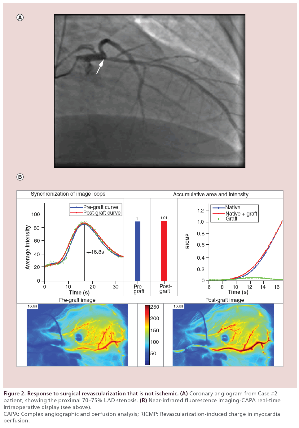 interventional-cardiology-revascularization-not-ischemic