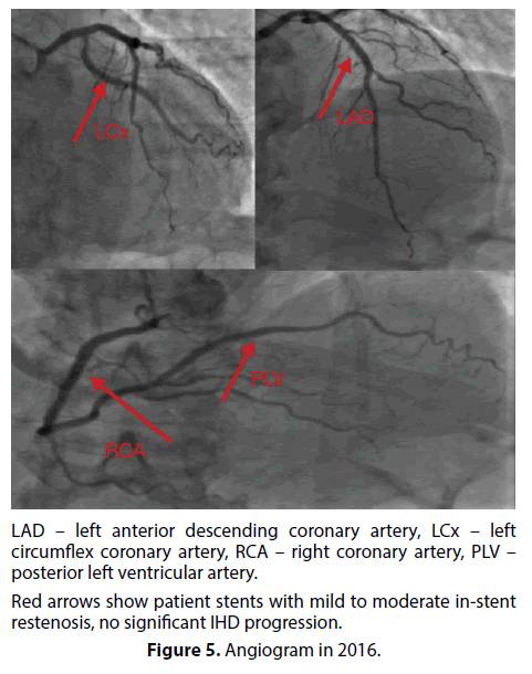 interventional-cardiology-right-coronary