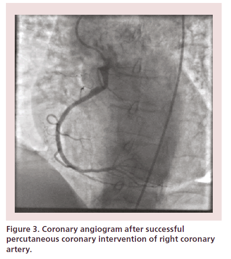 interventional-cardiology-right-coronary