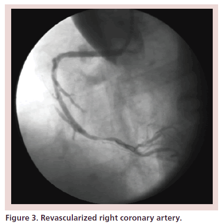 interventional-cardiology-right-coronary-artery