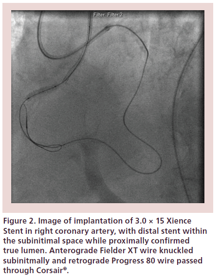 interventional-cardiology-right-coronary-artery