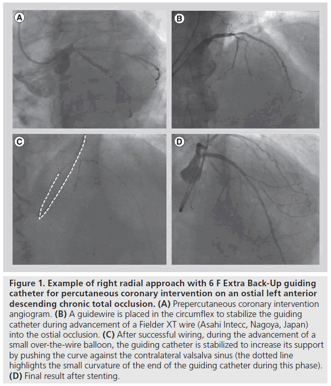 interventional-cardiology-right-radial-approach