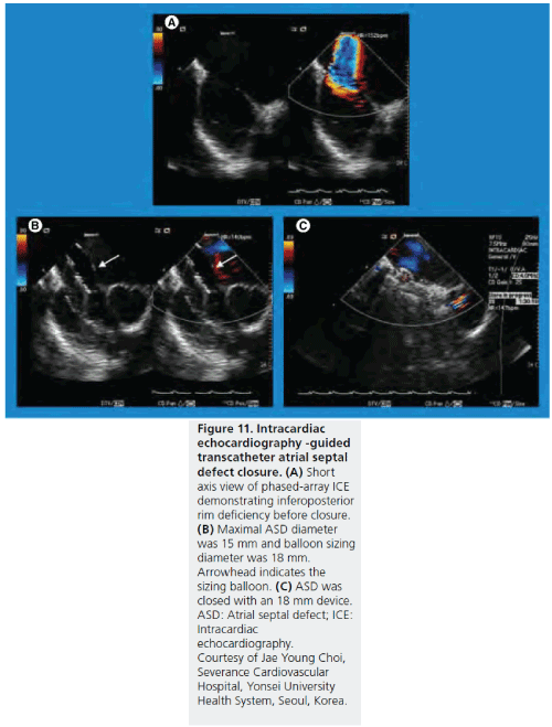 interventional-cardiology-septal