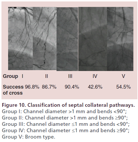 interventional-cardiology-septal