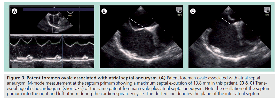 interventional-cardiology-septal-aneurysm