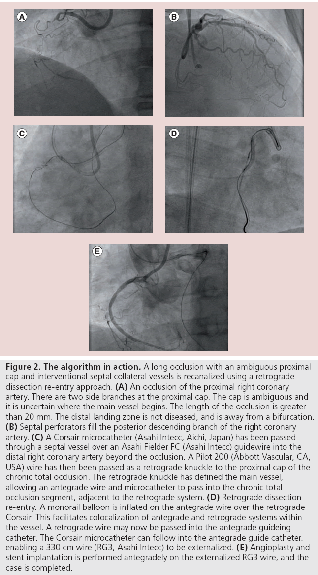 interventional-cardiology-septal-collateral-vessels