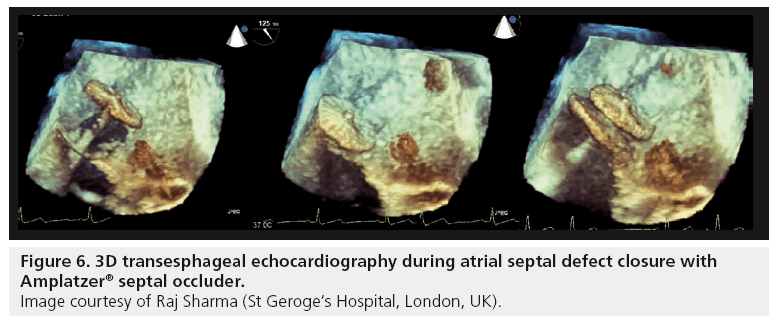 interventional-cardiology-septal-defect