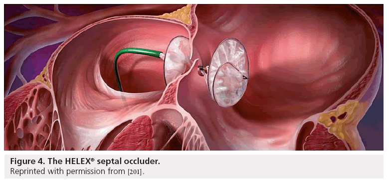 interventional-cardiology-septal-occluder