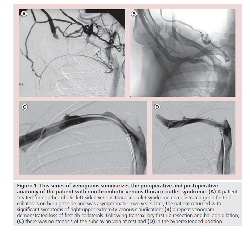 interventional-cardiology-series-venograms