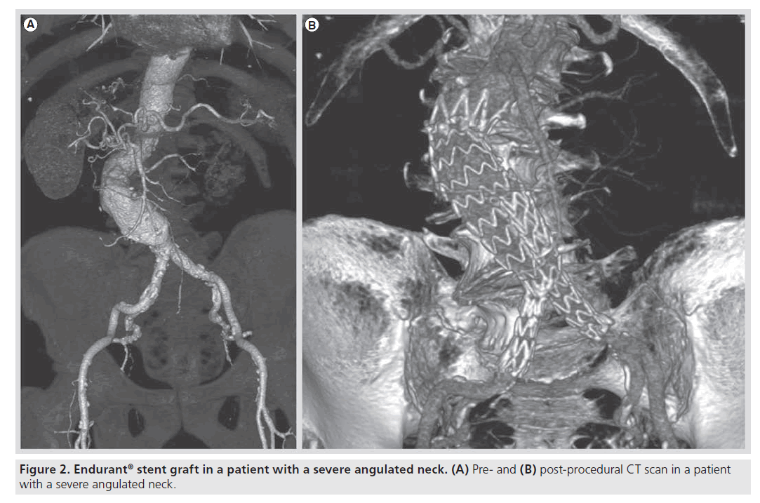 interventional-cardiology-severe-angulated