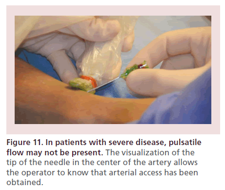 interventional-cardiology-severe-disease