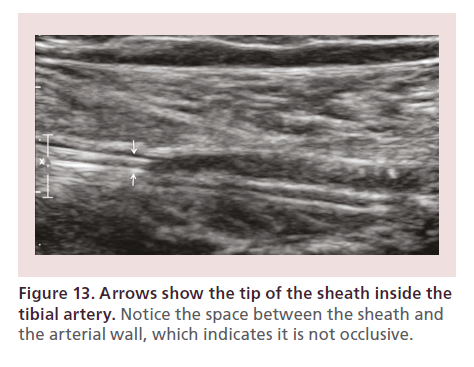 interventional-cardiology-sheath-inside