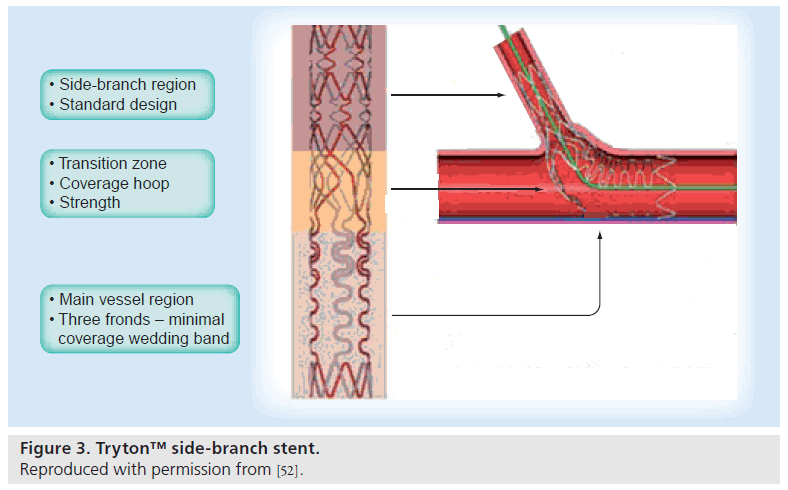 interventional-cardiology-side-branch-stent