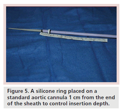interventional-cardiology-silicone-ring