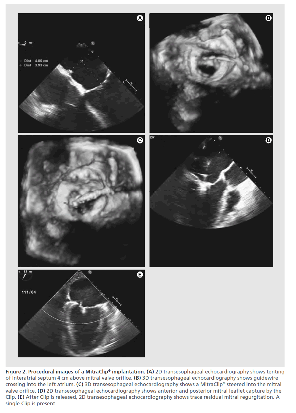 interventional-cardiology-single-Clip