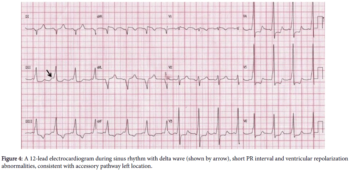 interventional-cardiology-sinus-rhythm