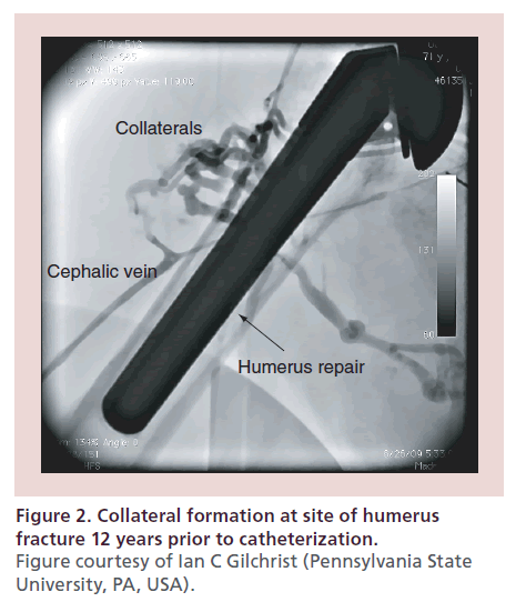 interventional-cardiology-site-humerus