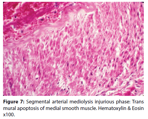 interventional-cardiology-smooth-muscle