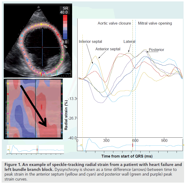 interventional-cardiology-speckle-tracking