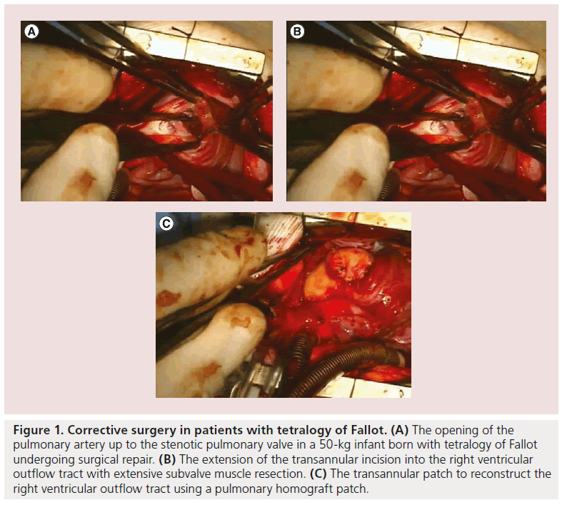 interventional-cardiology-stenotic-pulmonary