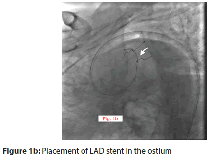 interventional-cardiology-stent