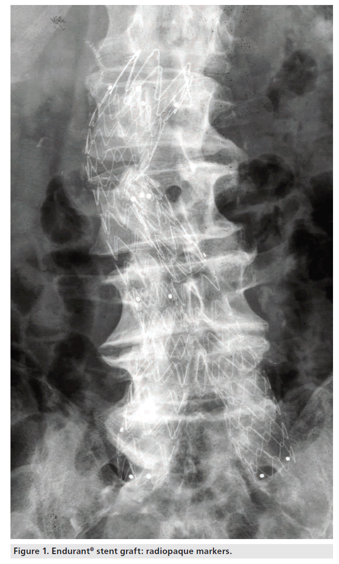 interventional-cardiology-stent-graft