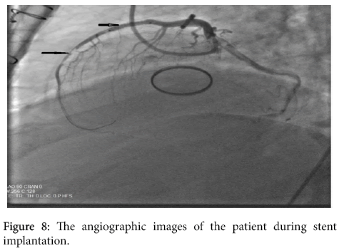 interventional-cardiology-stent-implantation