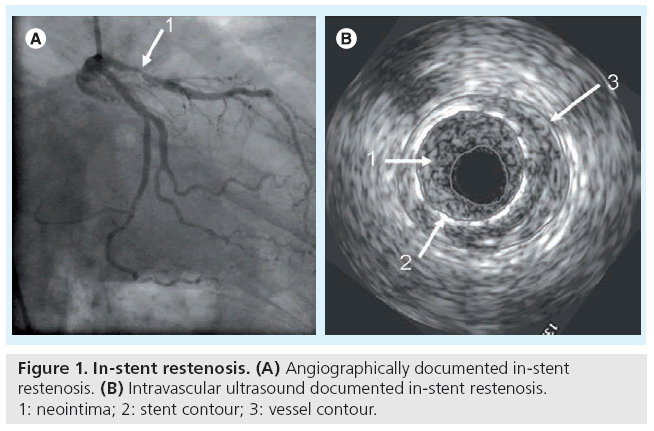 interventional-cardiology-stent-restenosis